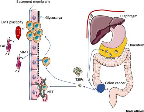 colon mets|met colon cancer.